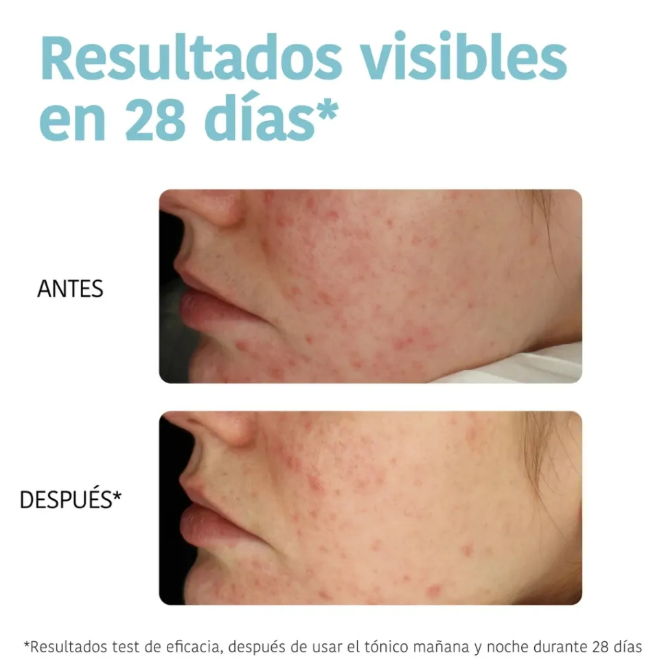 *Acne Prone Skin* - Discos tónico exfoliantes - Pieles acnéicas