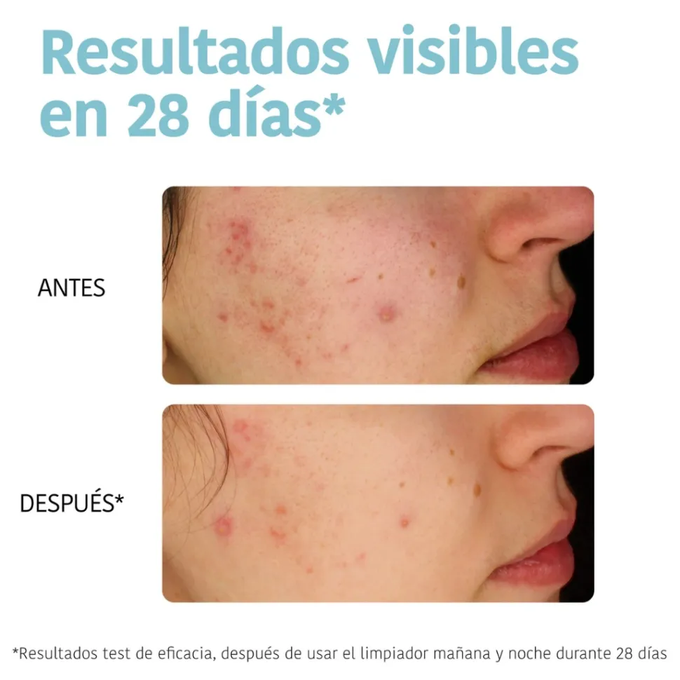 *Acne Prone Skin* - Limpiador purificante - Pieles acnéicas
