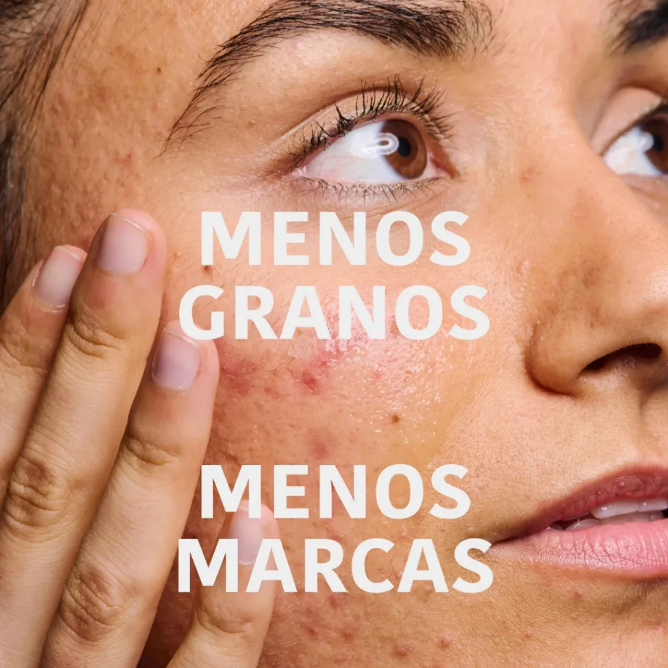 *Acne Prone Skin* - Sérum facial Prevent & Correct - Pieles acnéicas