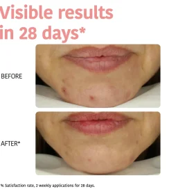 Mascarilla Perfect Skin Peeling - Ácido Glicólico