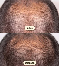 Tratamiento anticaída para el cabello Hair Growth & Density